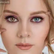 Grâce à la technique de Laser Monticelli, la kératopigmentation offre la possibilité de changer la couleur des yeux - clinique Monticelli Vélodrome Marseille