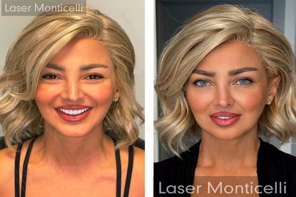 Modifier la couleur de ses yeux est possible grâce à la kératopigmentation réalisée avec Laser Monticelli.