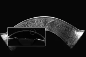 Pentacam® Cornea OCT avec Laser Monticelli et le docteur Jean christophe Pinelli 4